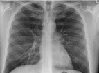 Radiografía de tórax